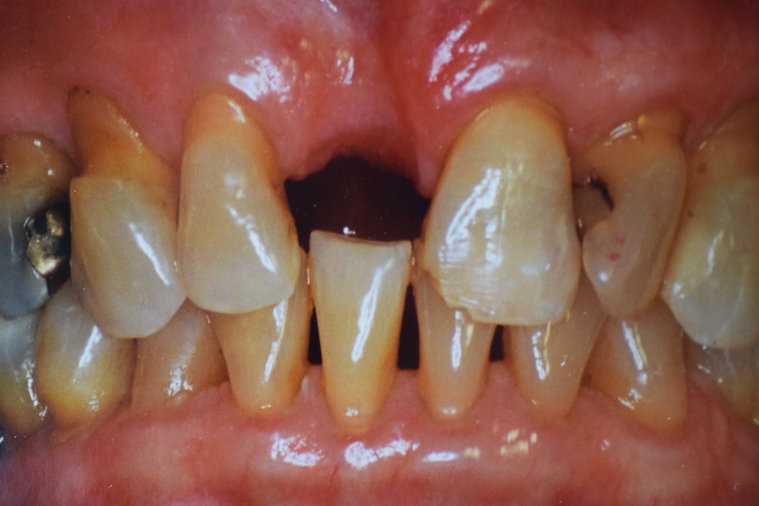 Before dental treatment