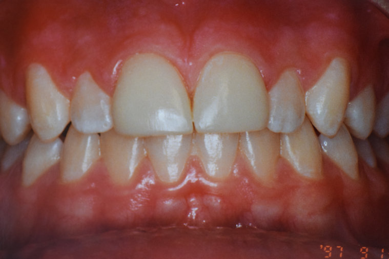 After dental treatment - improved smile