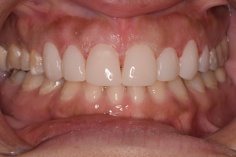 After dental treatment - improved smile