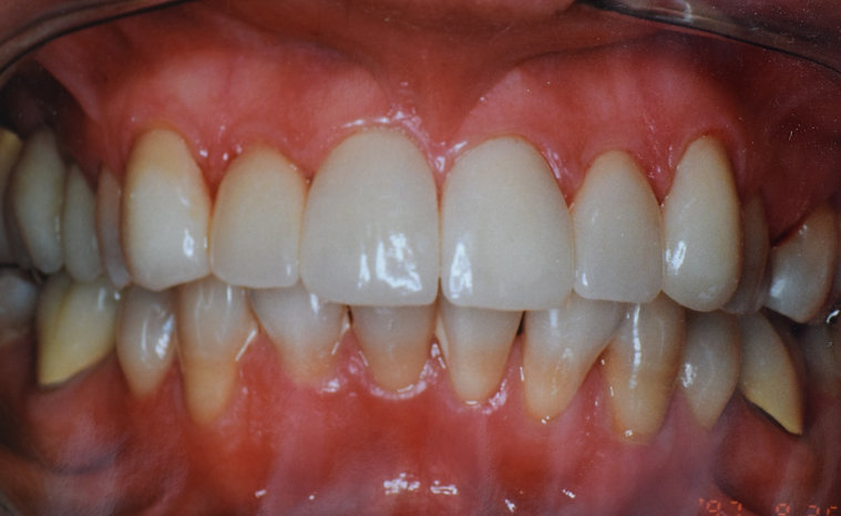 After dental treatment - improved smile