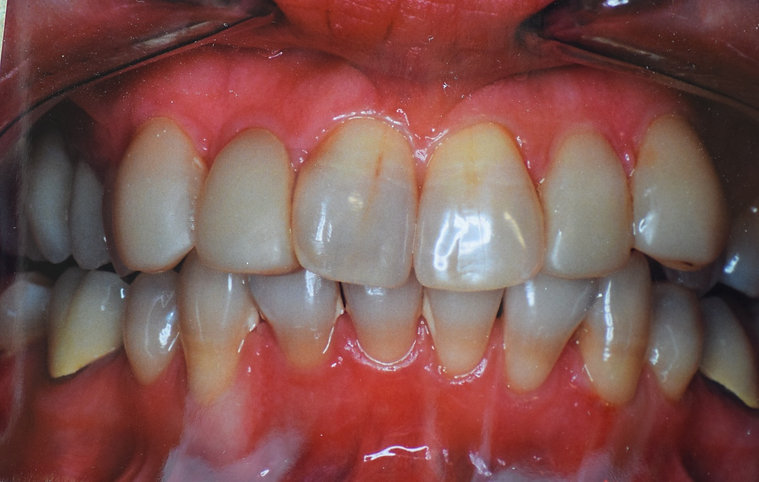 Before dental treatment