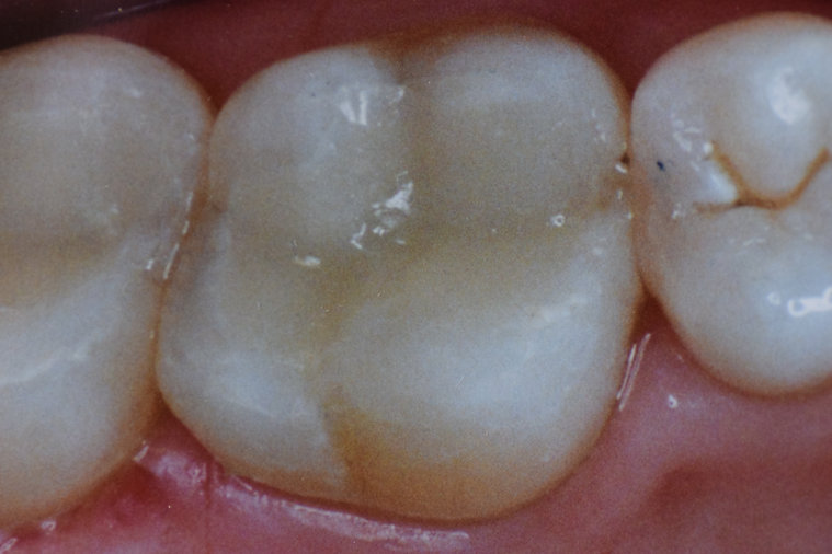 After dental treatment - improved smile