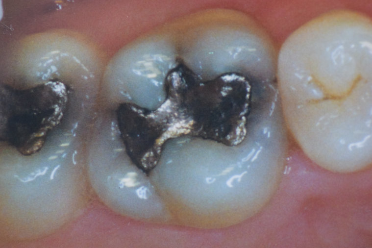 Before dental treatment