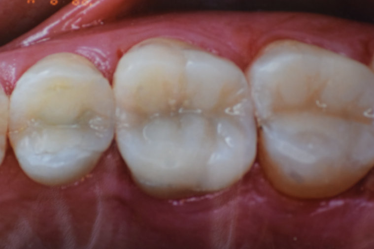 After dental treatment - improved smile