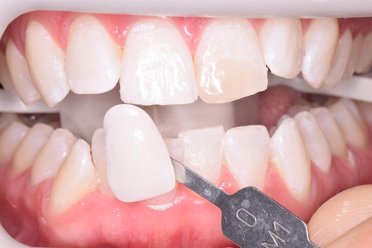 After dental treatment - improved smile