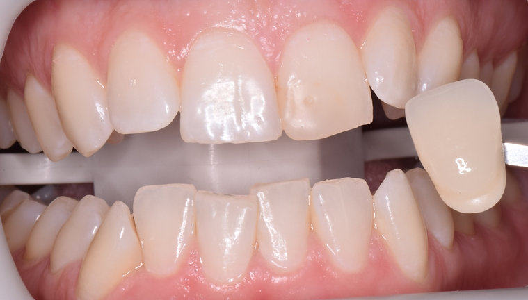 Before dental treatment